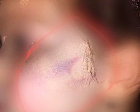 В детском саду в Алмалыке 2-летний ребёнок был жестоко избит воспитателем