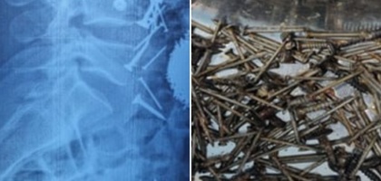 В Самарканде врачи спасли 29-летнего мужчину, проглотившего около 200 граммов гвоздей