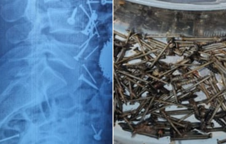 В Самарканде врачи спасли 29-летнего мужчину, проглотившего около 200 граммов гвоздей