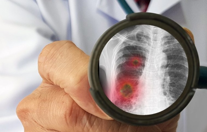 Koronovirus qachon zotiljamni keltirib chiqaradi?