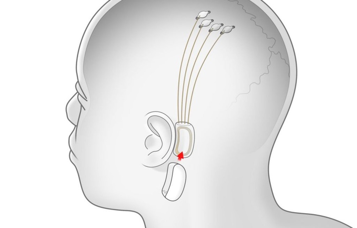 Илон Маск в следующем году начнет устанавливать в людей нейроинтерфейс Neuralink