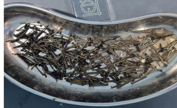 Samarqandda bemorning qornidan 200 gramm mix olib tashlandi