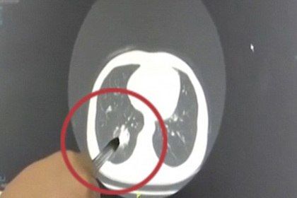 Хитойлик аёл 40 йил ўпкасида ручка қопқоғи билан яшаган