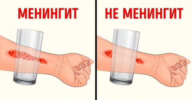 Тошкентга менингит касаллиги Россиядан кириб келган. Ундан қандай сақланиш мумкин?