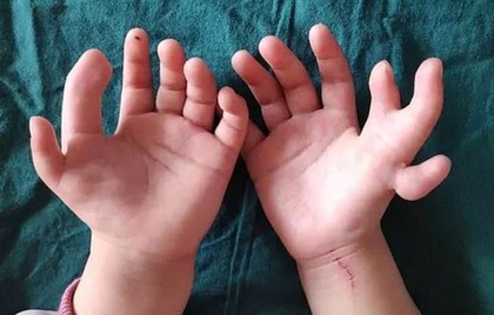 Китайские врачи отрезали девочке 4 лишних пальца